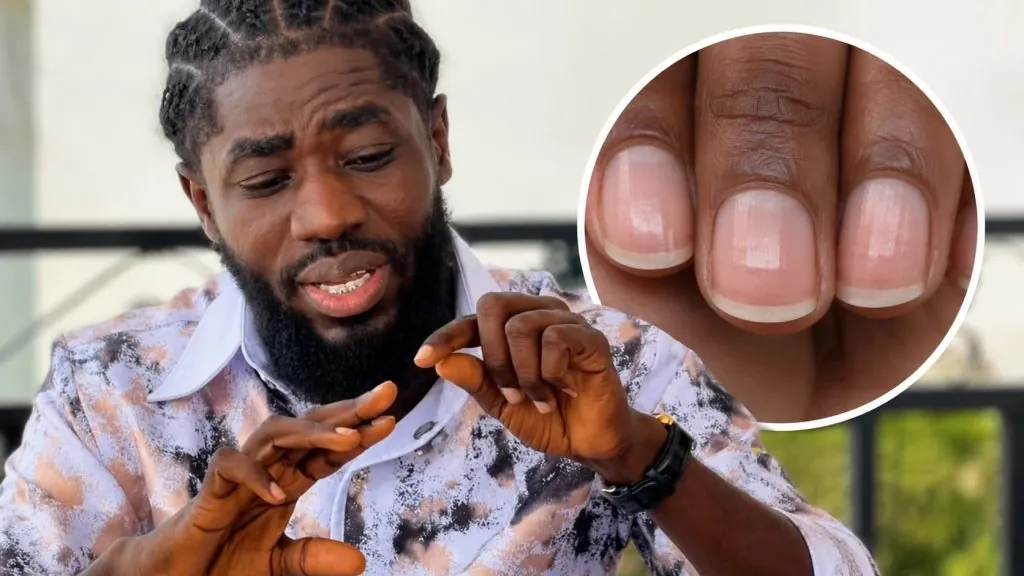 What Your Fingernails Reveal About Kidney Health: Expert Insights Explained