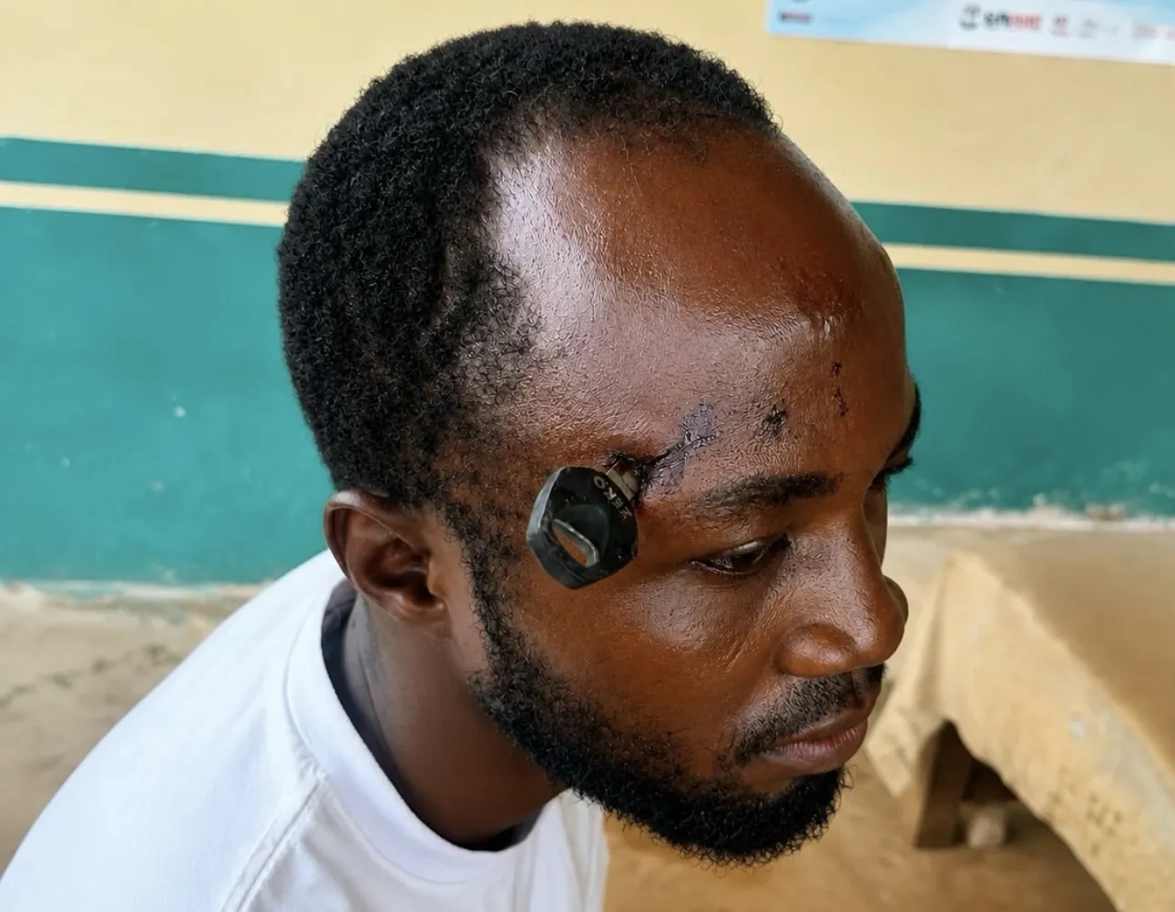 Man Hospitalised After Motorcycle Key Becomes Lodged in Skull While Breaking Up Jasikan Okada Fight